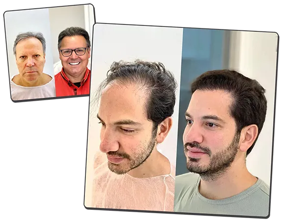 Voor en na resultaten haartransplantatie